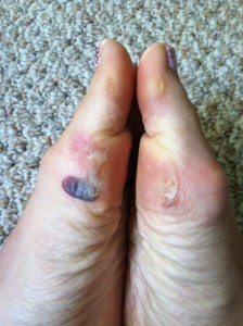 Nasty blisters, ugly runners feet